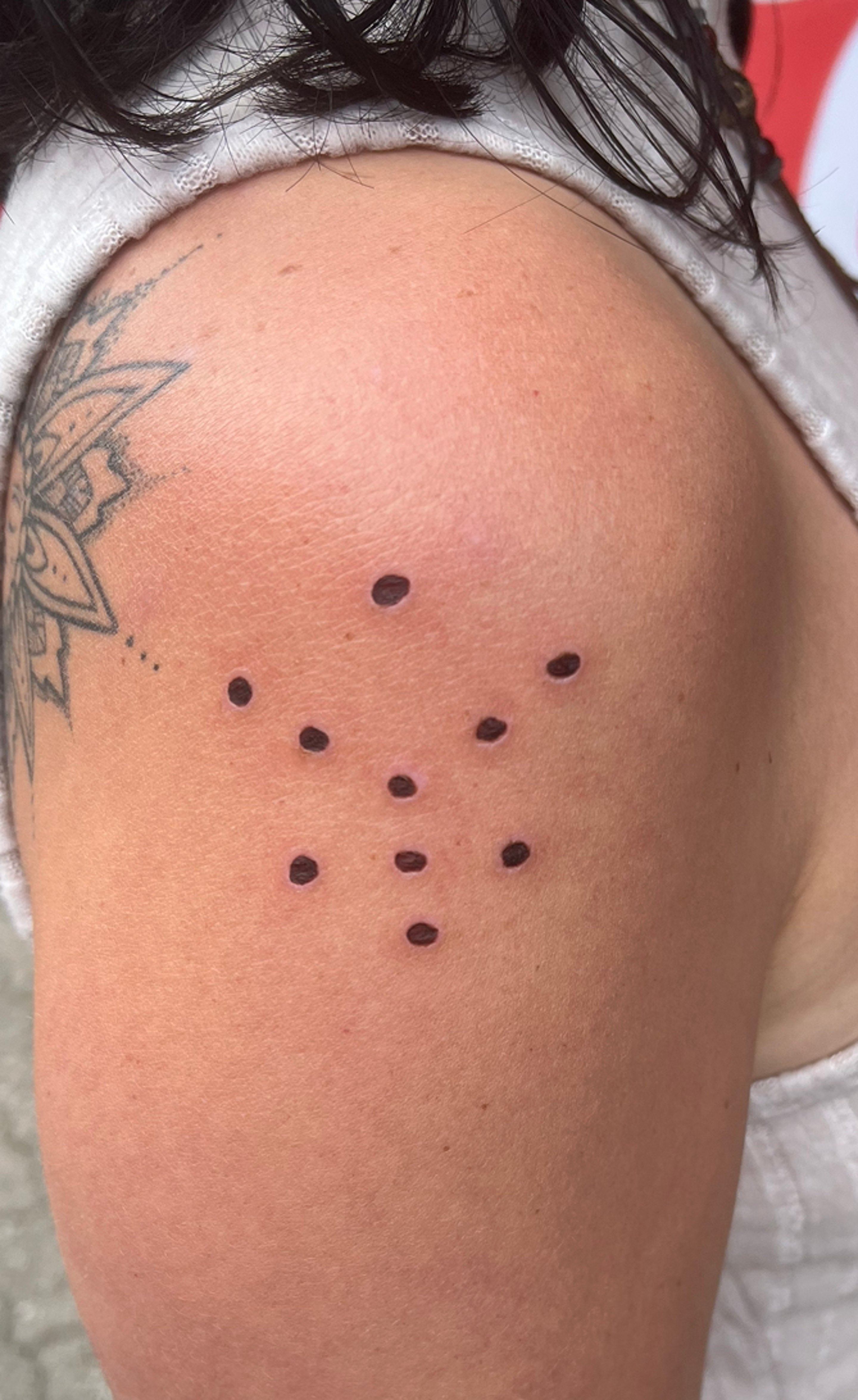 Kambo-Gates auf der Haut nach einer Sitzung