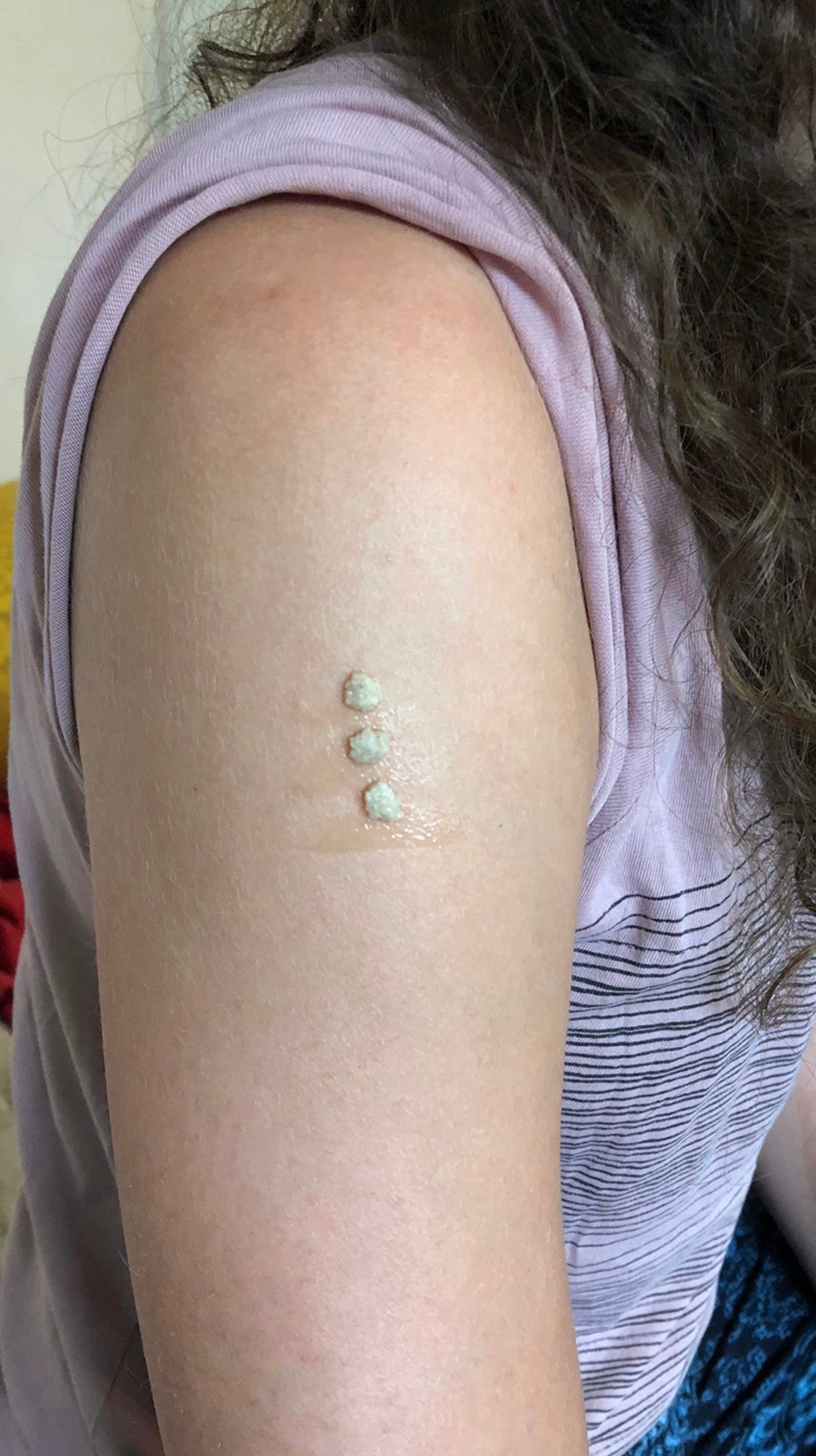 Traditionelle Kambo-Behandlung — Gates am Oberarm