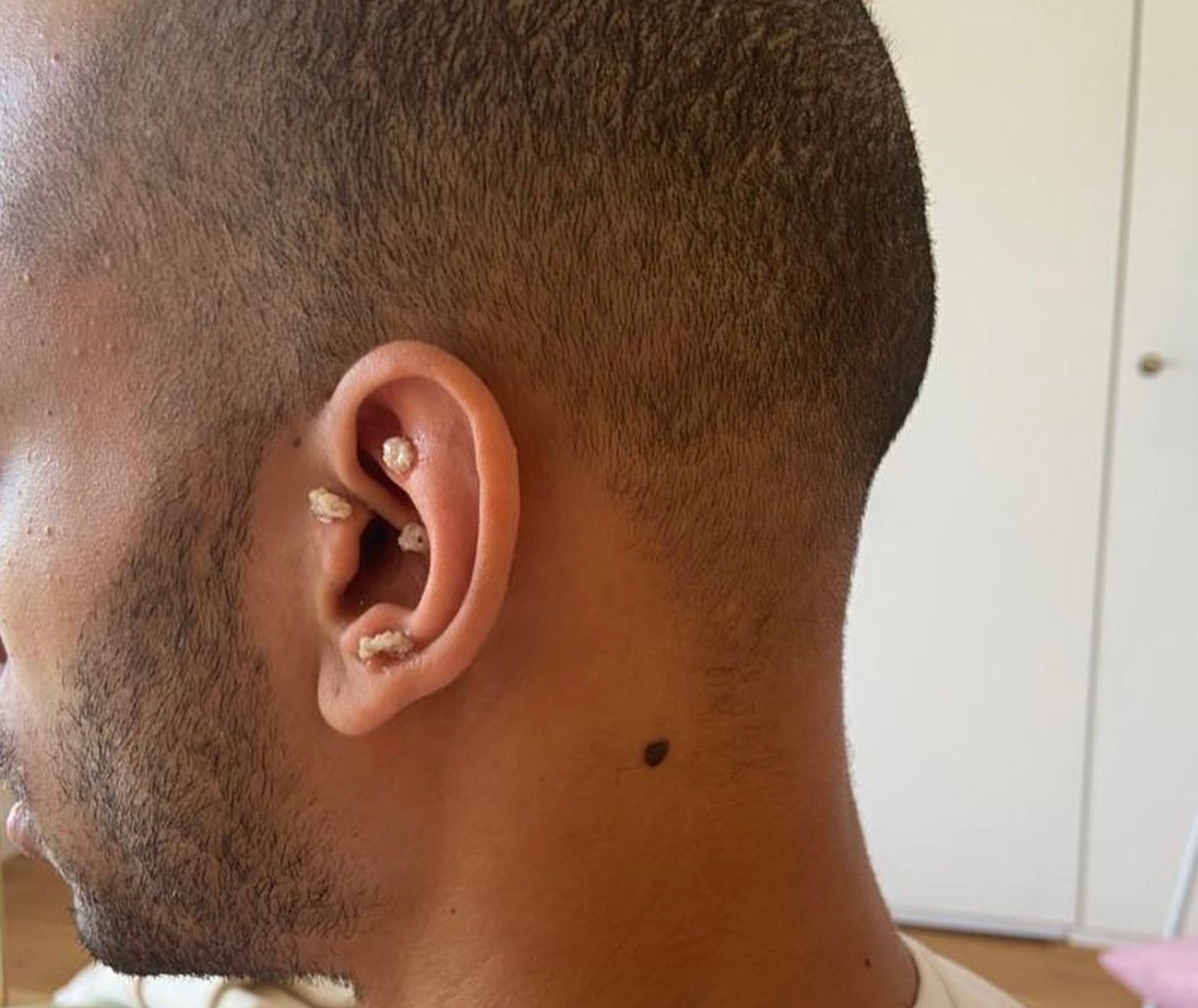 Ohr-Kambo — Mikrokosmos-Behandlung am Ohr